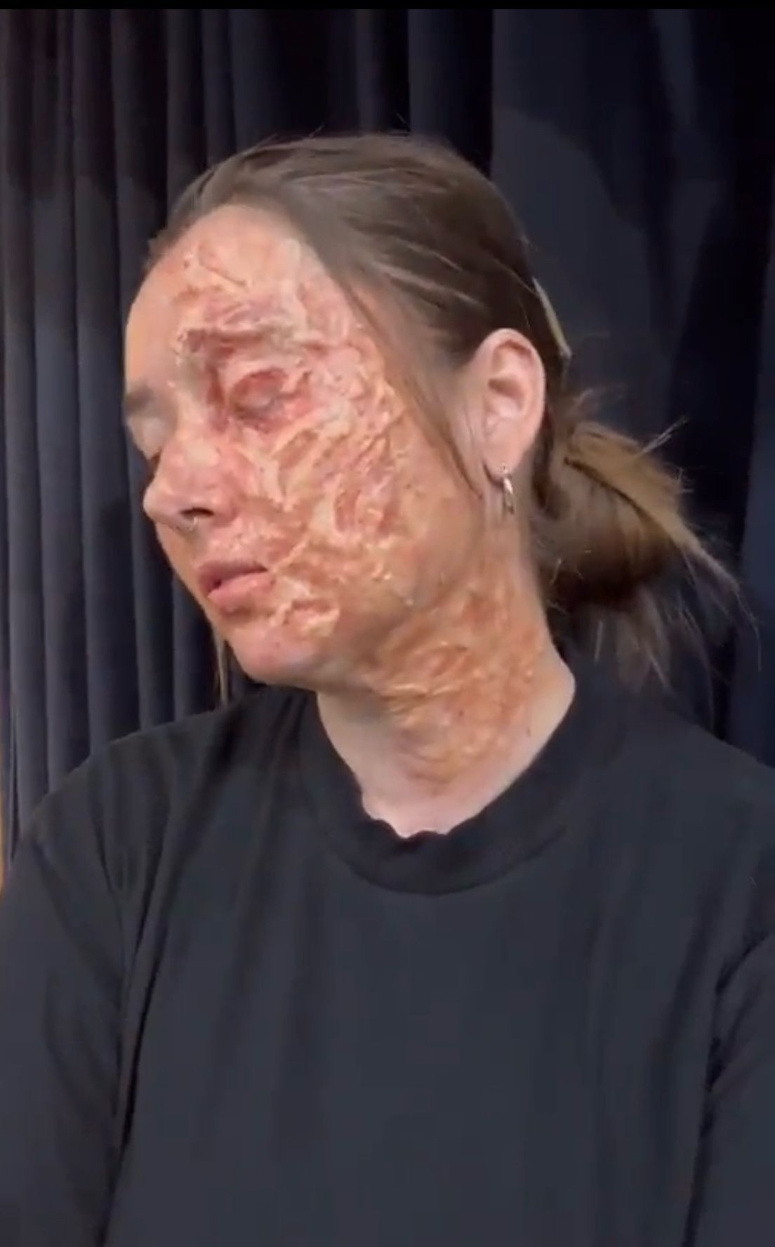 Student with prosthetic burn marks on her face