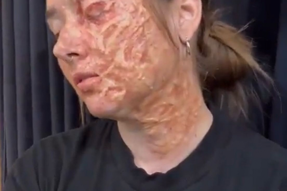 Student with prosthetic burn marks on her face