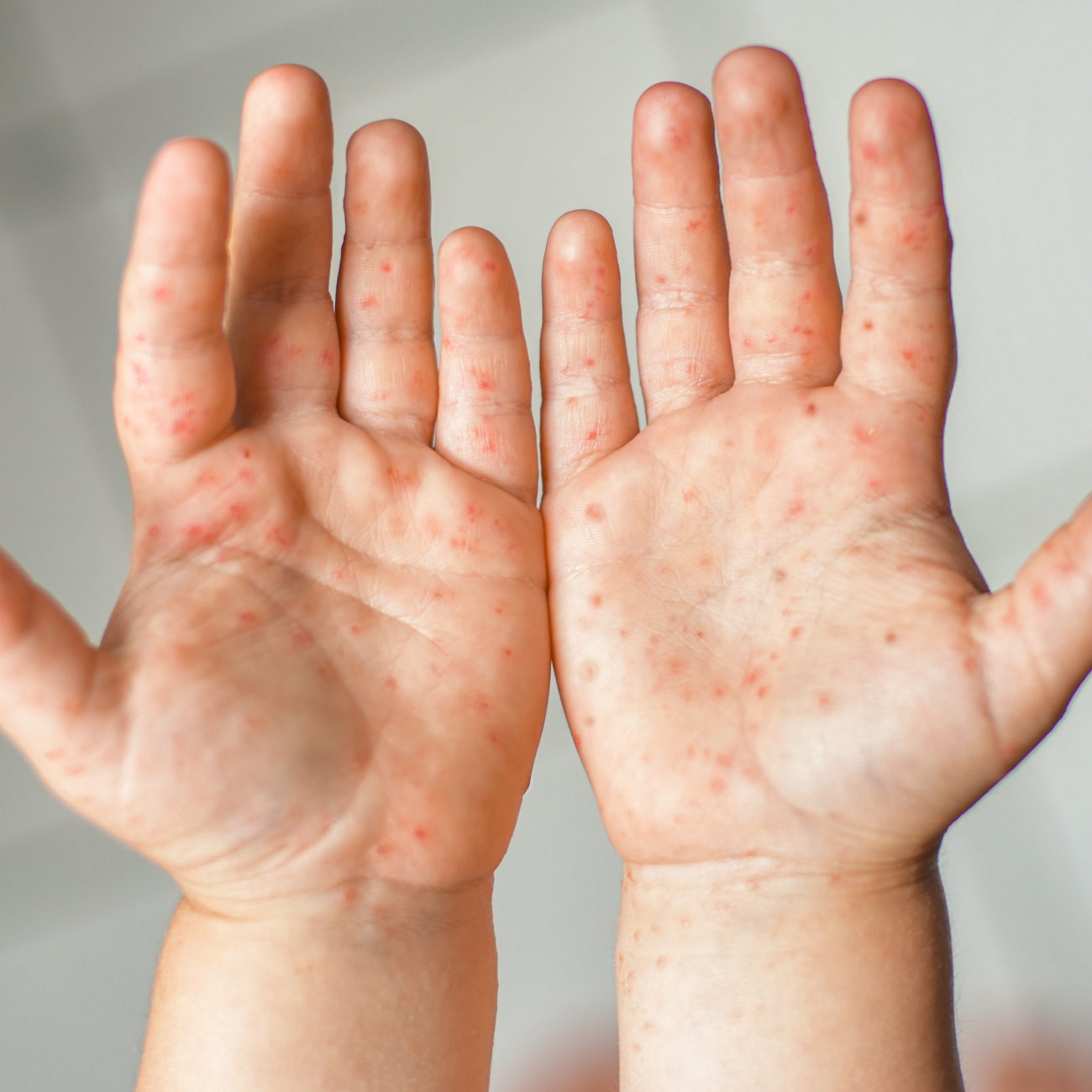 Enterovirus Leg arm mouth Rash on the body of a child Cocksackie virus